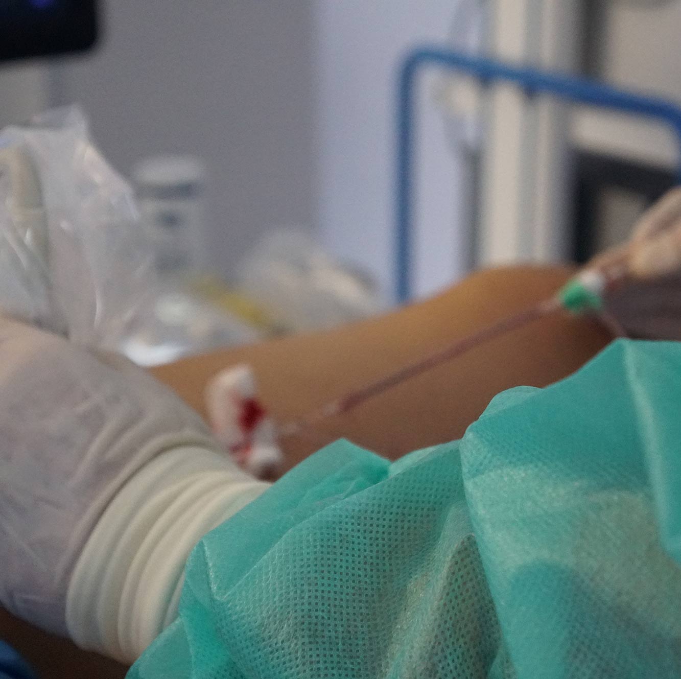 Leczenie żylaków laserem